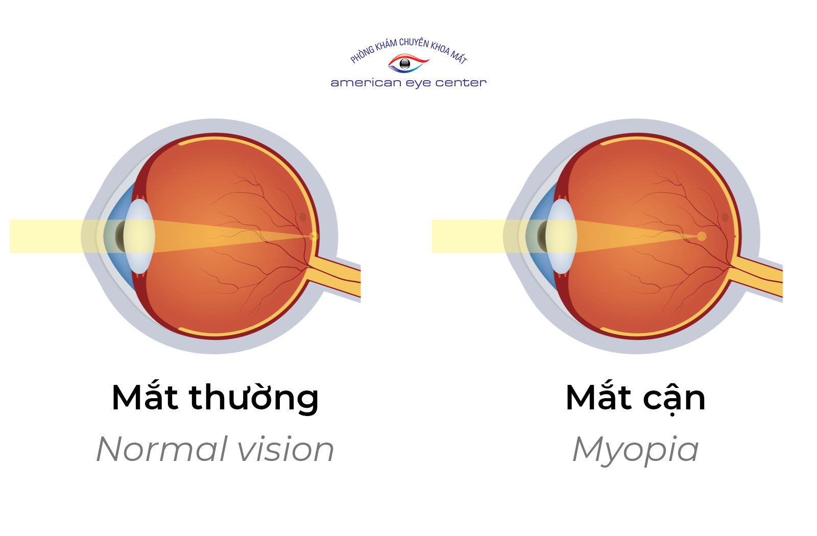Điều trị kiểm soát cận thị cùng American Eye Center Vietnam