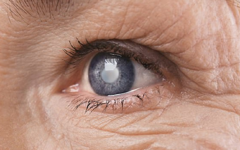 Cataracts caused by Ultraviolet (UV) light
