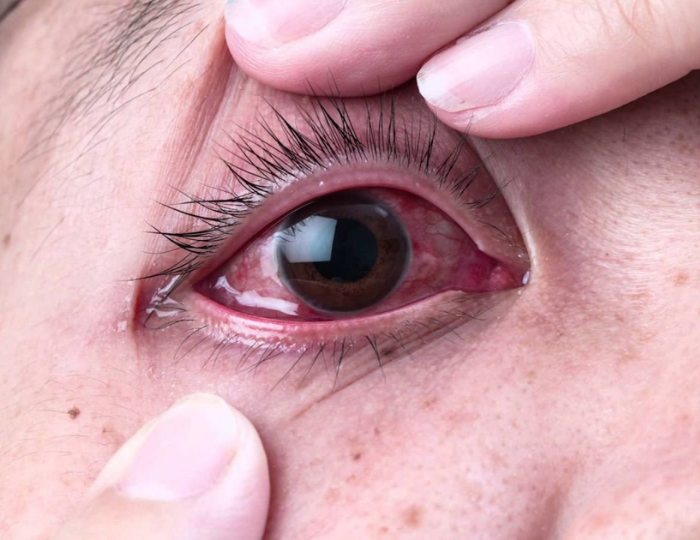 IS ITCHY AND RED EYES A SYMPTOM OF THE NEW COVID-19 VARIANT?