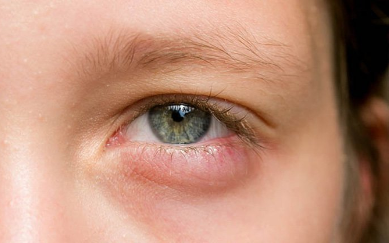 nhiễm trùng mắt cần đi khám mắt ngay