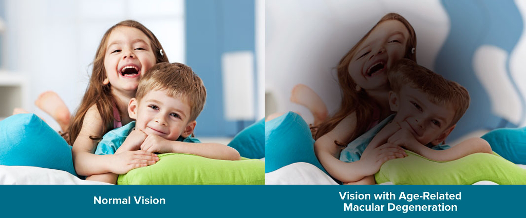 Tho&aacute;i h&oacute;a ho&agrave;ng điểm (Cataract) tại American Eye Center vietnam