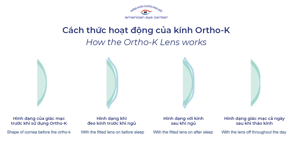 Ortho-K cho trẻ em